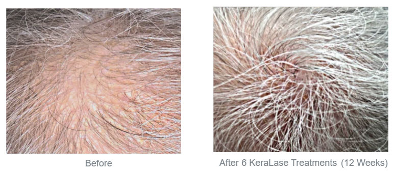 hair loss treatment - before & after