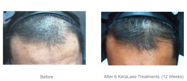 hair loss treatment - before & after
